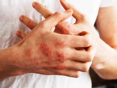 Thumb psoriasi